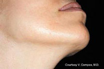 photo of same chin after laser hair removal treatment