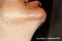 photo of chin before laser hair removal treatment