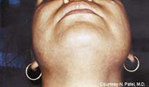 photo of same woman's chin and neck after laser hair removal treatment