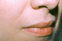 photo of same upper lip after laser hair removal treatment