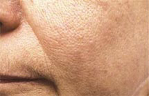 photo of same cheek after photo rejuvenation treatment