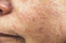 photo of cheek showing capillaries before treatment