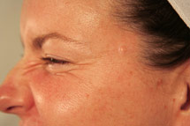 photo of same woman's face after Botox treatment