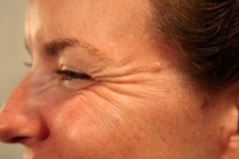 photo of woman's face with crow's feet before Botox treatment