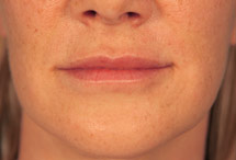front view of lips after dermal filler treatment