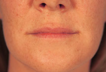front view of lips before dermal filler treatment