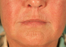 photo of woman's mouth after dermal filler treatment showing reduced marionette lines