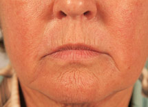 photo of woman's mouth before dermal filler treatment, showing marionette lines