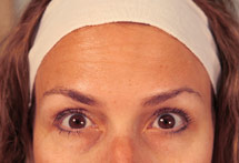 photo of same woman's face after Botox treatment