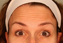 photo of woman's face with forehead wrinkles
