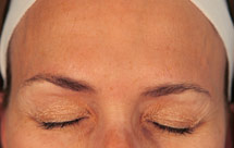 photo of same woman's face after Botox treatment