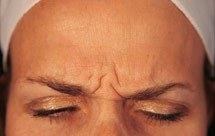 photo of woman's face with frown lines between eyebrows