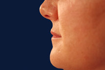 profile of woman's face before dermal filler treatment