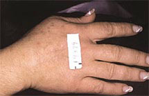 photo of same hand after photo rejuvenation treatment