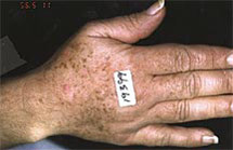 photo of hand showing dark sunspots before treatment
