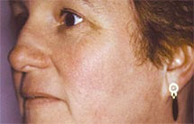 photo of same woman showing cheek after photo rejuvenation treatment